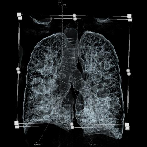 Obraz płuc pacjenta z zespołem Moinier-Kuhna
