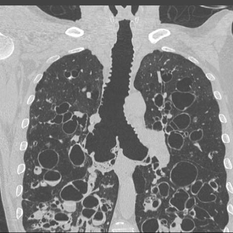 Obraz zniszczonych płuc pacjenta z zespołem Moinier-Kuhna