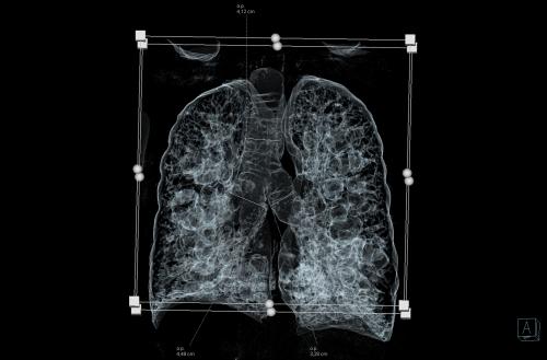 Obraz płuc pacjenta z zespołem Moiniera-Kuhna