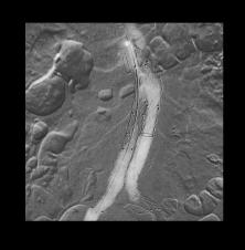 Zabieg EVAR z użyciem angiografii CO₂ - Zdjęcie główne